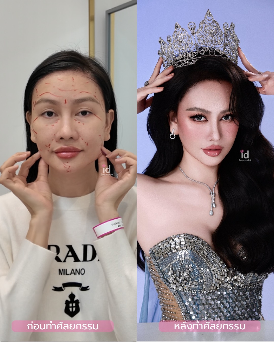 ภาพก่อน–หลังออกแบบใบหน้าจากโรงพยาบาลไอดี
