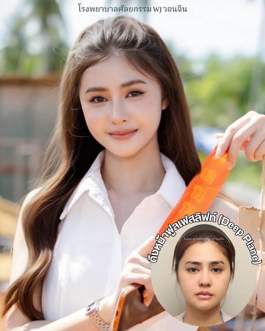 ภาพก่อน–หลังดึงหน้าฟูลเฟสลิฟท์จากโรงพยาบาลวอนจิน