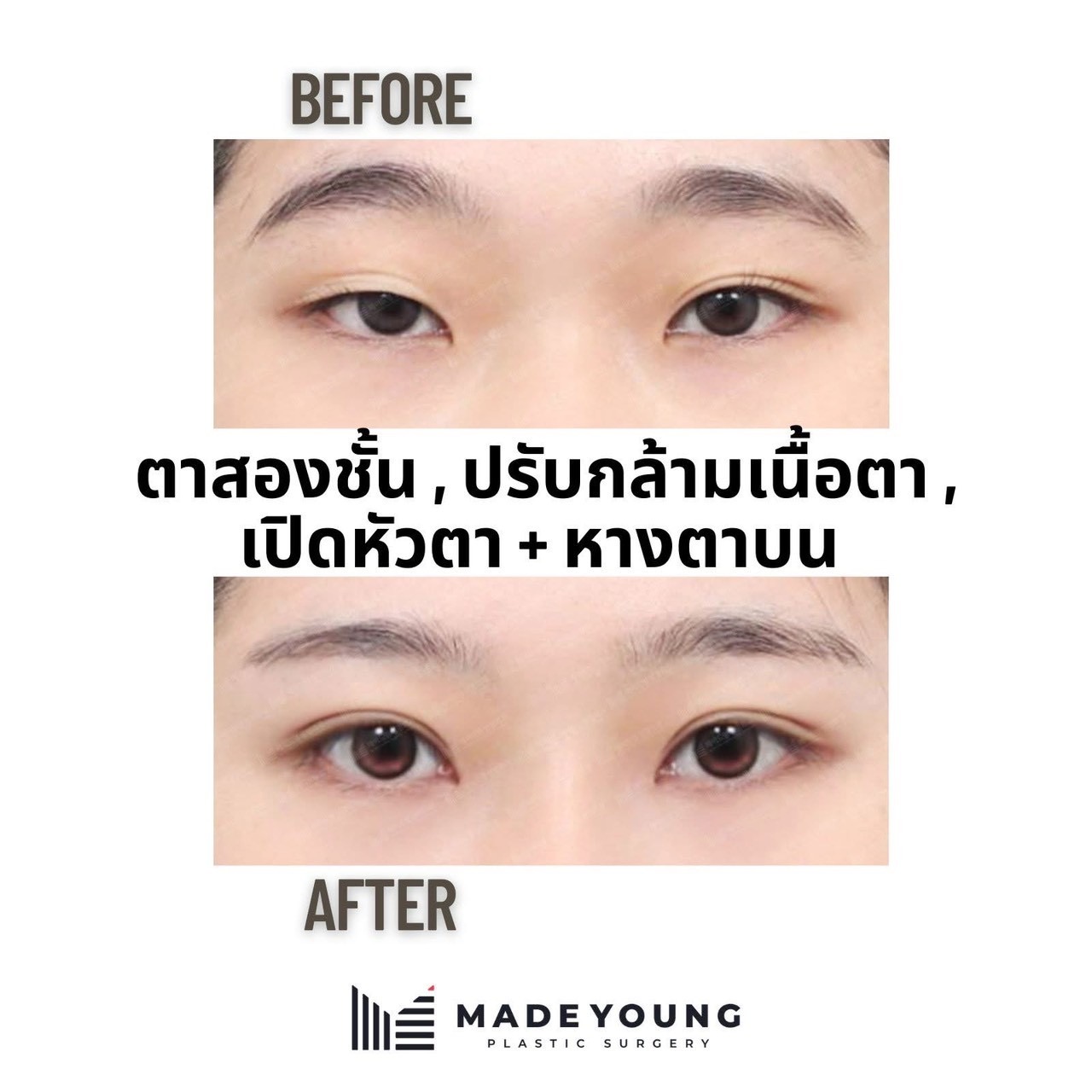 ภาพก่อน–หลังทำตาสองชั้นและเปิดหัวตาจาก MadeYoung