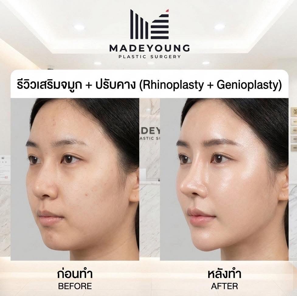 ภาพก่อน–หลังเสริมจมูกและปรับคางจาก MadeYoung