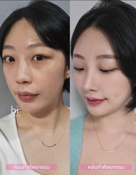 ภาพก่อน–หลังปรับกล้ามเนื้อตาจาก BT Plastic Surgery